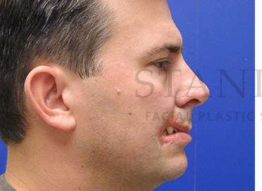 Lip Reconstruction Before & After Patient #691