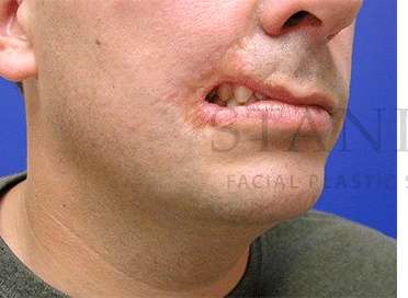 Lip Reconstruction Before & After Patient #691