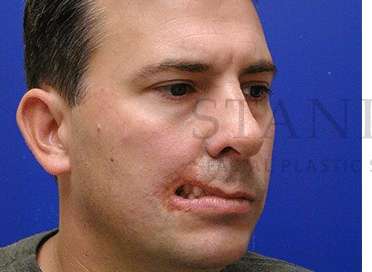 Lip Reconstruction Before & After Patient #691