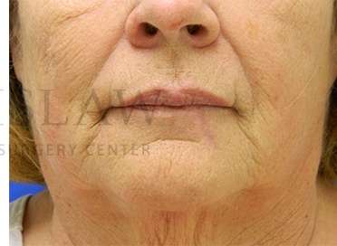 Lip Reconstruction Before & After Patient #680