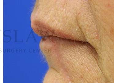 Lip Reconstruction Before & After Patient #680