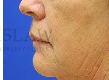 Lip Reconstruction Before & After Patient #680
