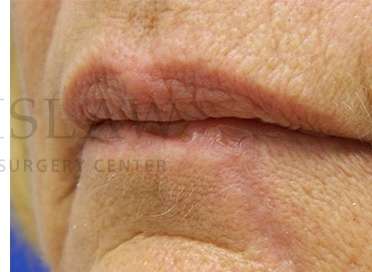 Lip Reconstruction Before & After Patient #680