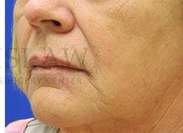 Lip Reconstruction Before & After Patient #680