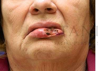 Lip Reconstruction Before & After Patient #680