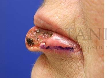 Lip Reconstruction Before & After Patient #680