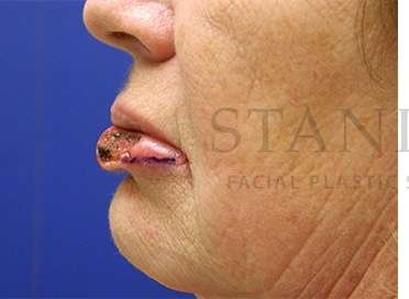 Lip Reconstruction Before & After Patient #680