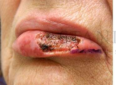 Lip Reconstruction Before & After Patient #680