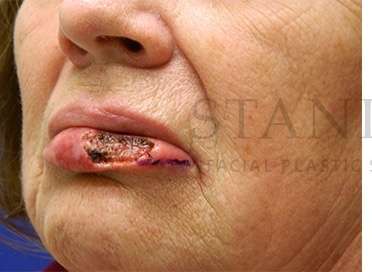 Lip Reconstruction Before & After Patient #680