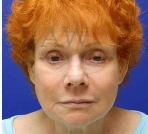 Liquid Facelift Before & After Patient #737