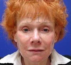 Liquid Facelift Before & After Patient #737