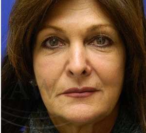 Liquid Facelift Before & After Patient #734