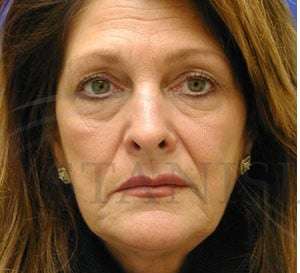 Liquid Facelift Before & After Patient #734