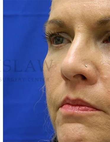 Liquid Facelift Before & After Patient #731