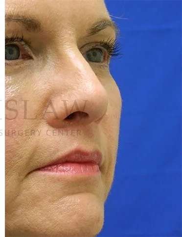 Liquid Facelift Before & After Patient #731