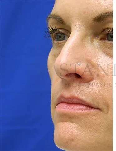 Liquid Facelift Before & After Patient #731