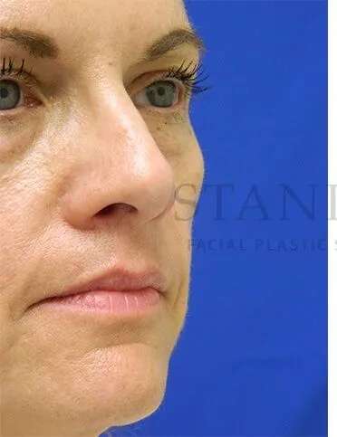 Liquid Facelift Before & After Patient #731