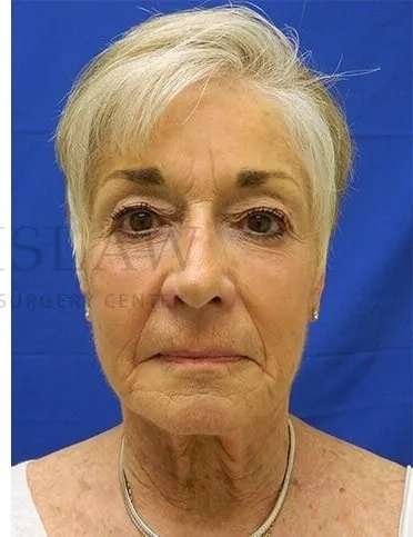 Liquid Facelift Before & After Patient #720