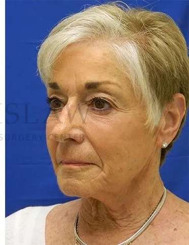 Liquid Facelift Before & After Patient #720