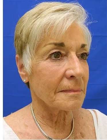 Liquid Facelift Before & After Patient #720