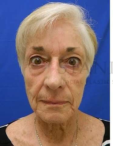 Liquid Facelift Before & After Patient #720