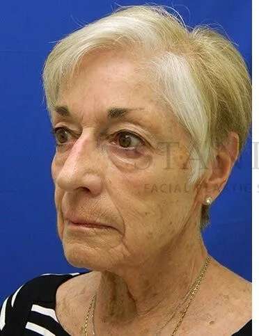Liquid Facelift Before & After Patient #720