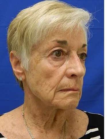 Liquid Facelift Before & After Patient #720