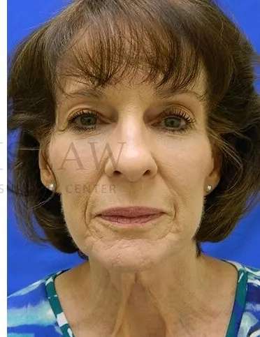 Liquid Facelift Before & After Patient #713