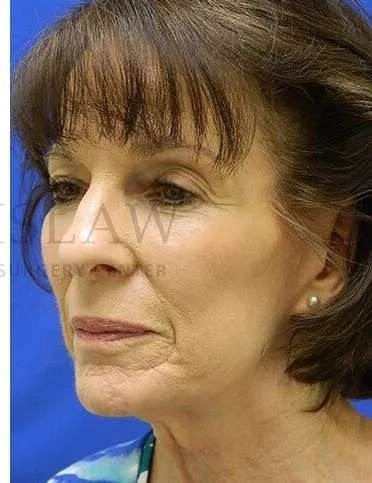 Liquid Facelift Before & After Patient #713