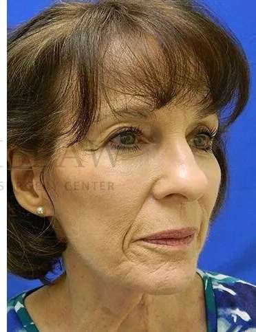 Liquid Facelift Before & After Patient #713
