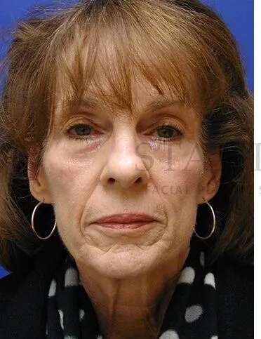 Liquid Facelift Before & After Patient #713