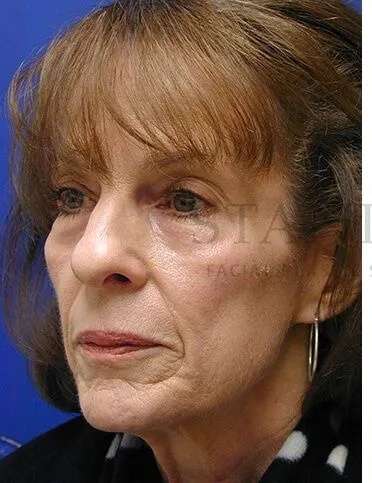 Liquid Facelift Before & After Patient #713