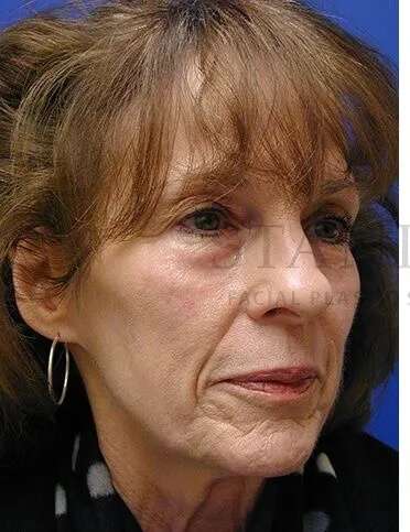 Liquid Facelift Before & After Patient #713