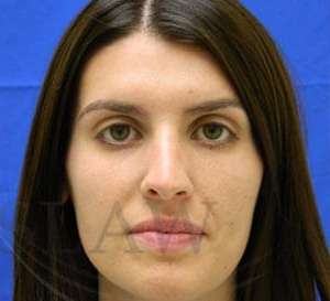 Liquid Rhinoplasty Before & After Patient #780