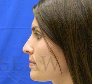 Liquid Rhinoplasty Before & After Patient #780