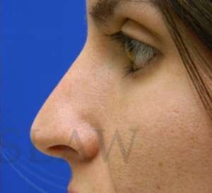Liquid Rhinoplasty Before & After Patient #780