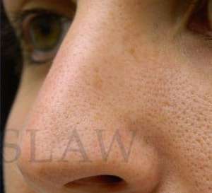 Liquid Rhinoplasty Before & After Patient #780