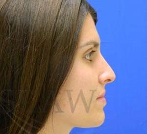 Liquid Rhinoplasty Before & After Patient #780