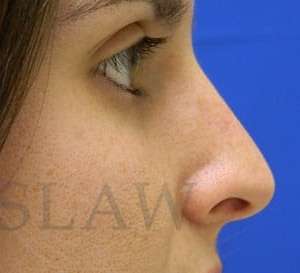Liquid Rhinoplasty Before & After Patient #780