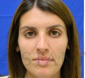 Liquid Rhinoplasty Before & After Patient #780