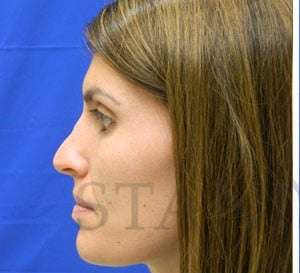 Liquid Rhinoplasty Before & After Patient #780