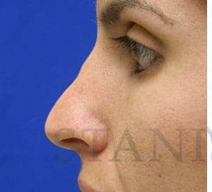 Liquid Rhinoplasty Before & After Patient #780