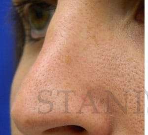 Liquid Rhinoplasty Before & After Patient #780