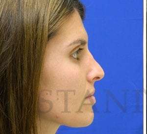 Liquid Rhinoplasty Before & After Patient #780