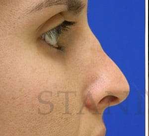 Liquid Rhinoplasty Before & After Patient #780