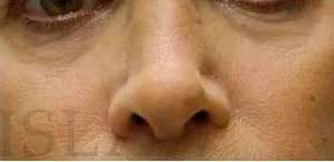 Liquid Rhinoplasty Before & After Patient #744