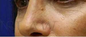 Liquid Rhinoplasty Before & After Patient #744