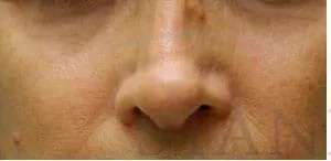 Liquid Rhinoplasty Before & After Patient #744