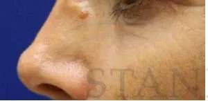 Liquid Rhinoplasty Before & After Patient #744