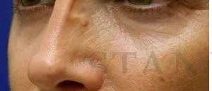 Liquid Rhinoplasty Before & After Patient #744